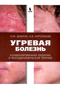 Купить Угревая болезнь. Комбинированная лазерная и фотодинамическая терапия — Фото №1