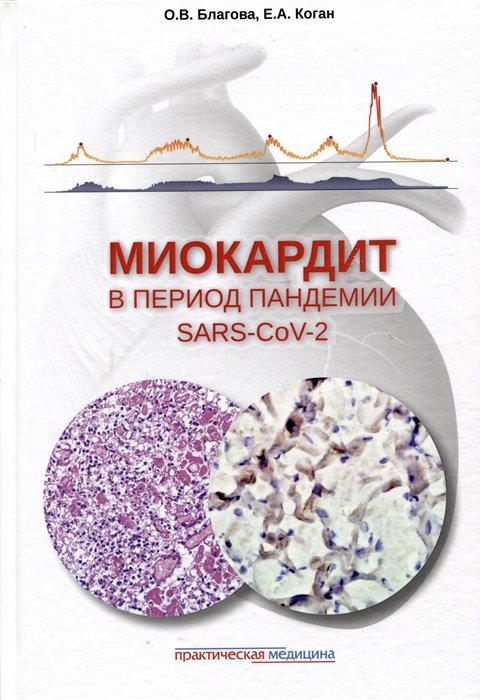

Миокардит в период пандемии SARS-CoV-2