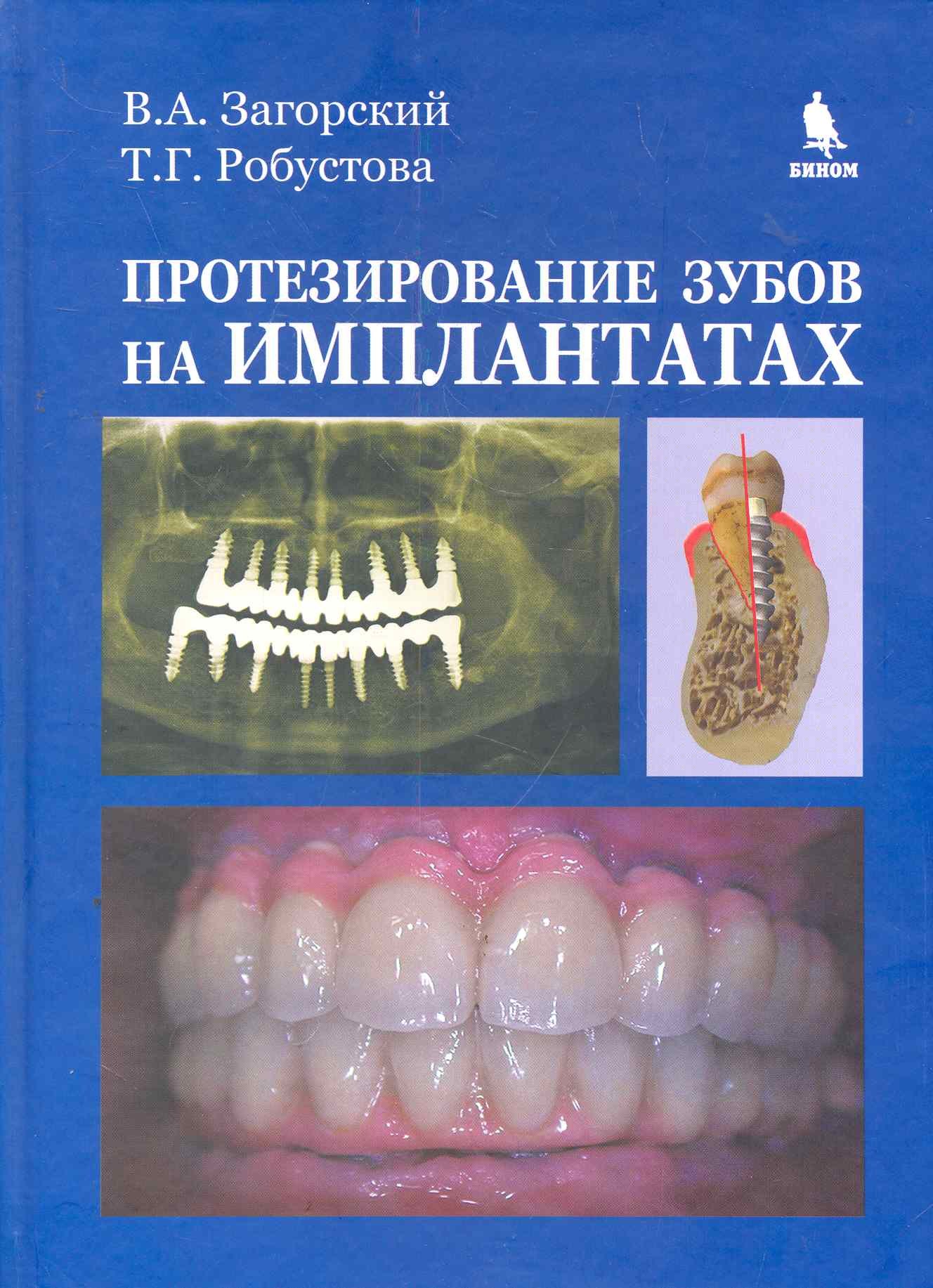 

Протезирование зубов на имплантатах.