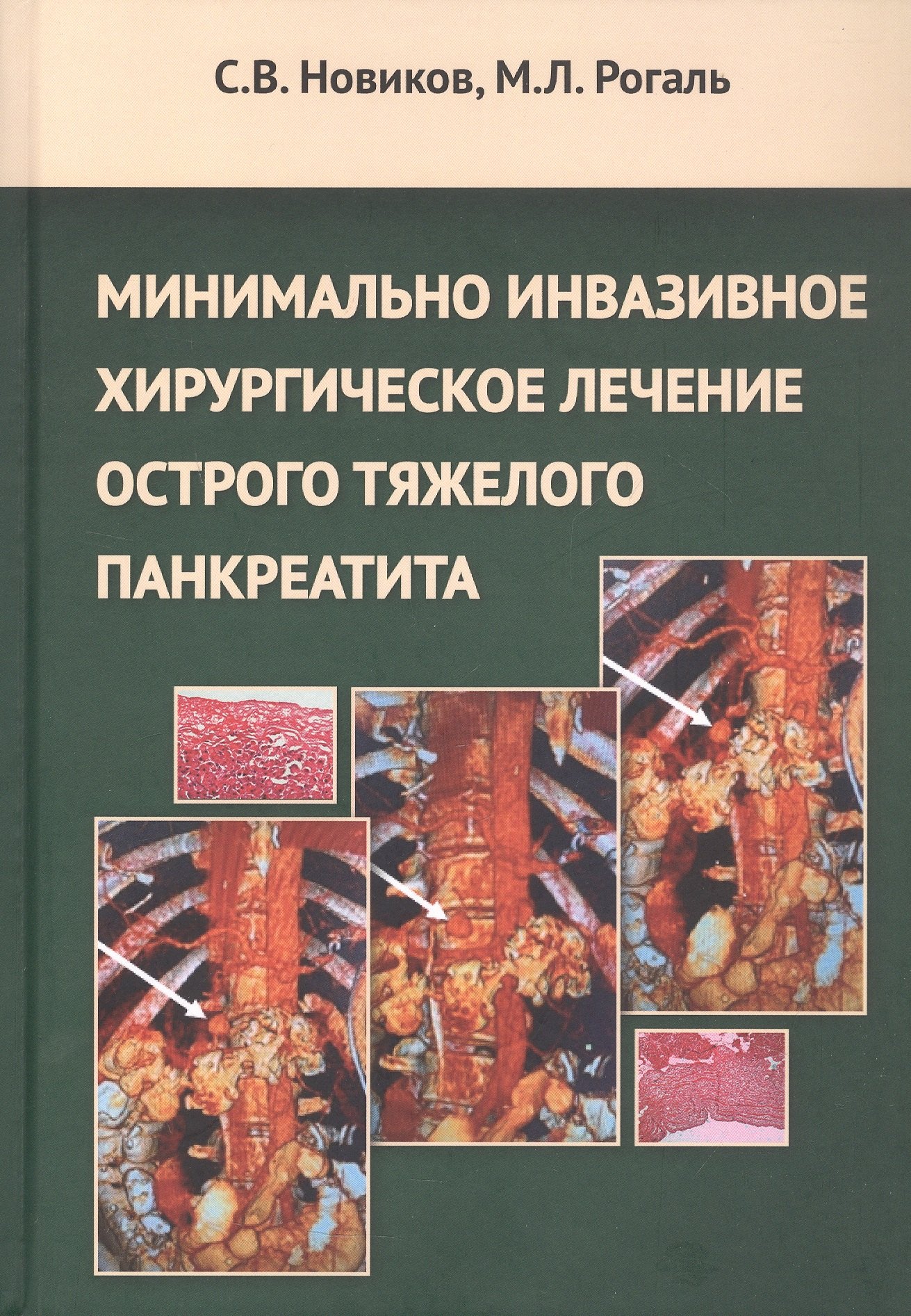 

Минимальное инвазивное хирургическое лечение острого тяжелого панкреатита. Монография