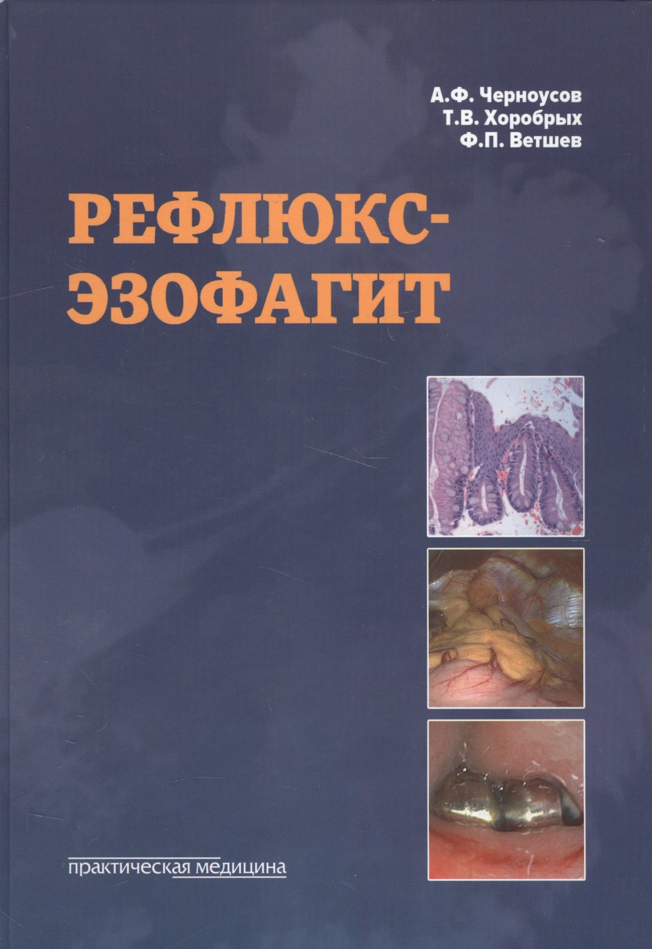 

Рефлюкс-эзофагит.