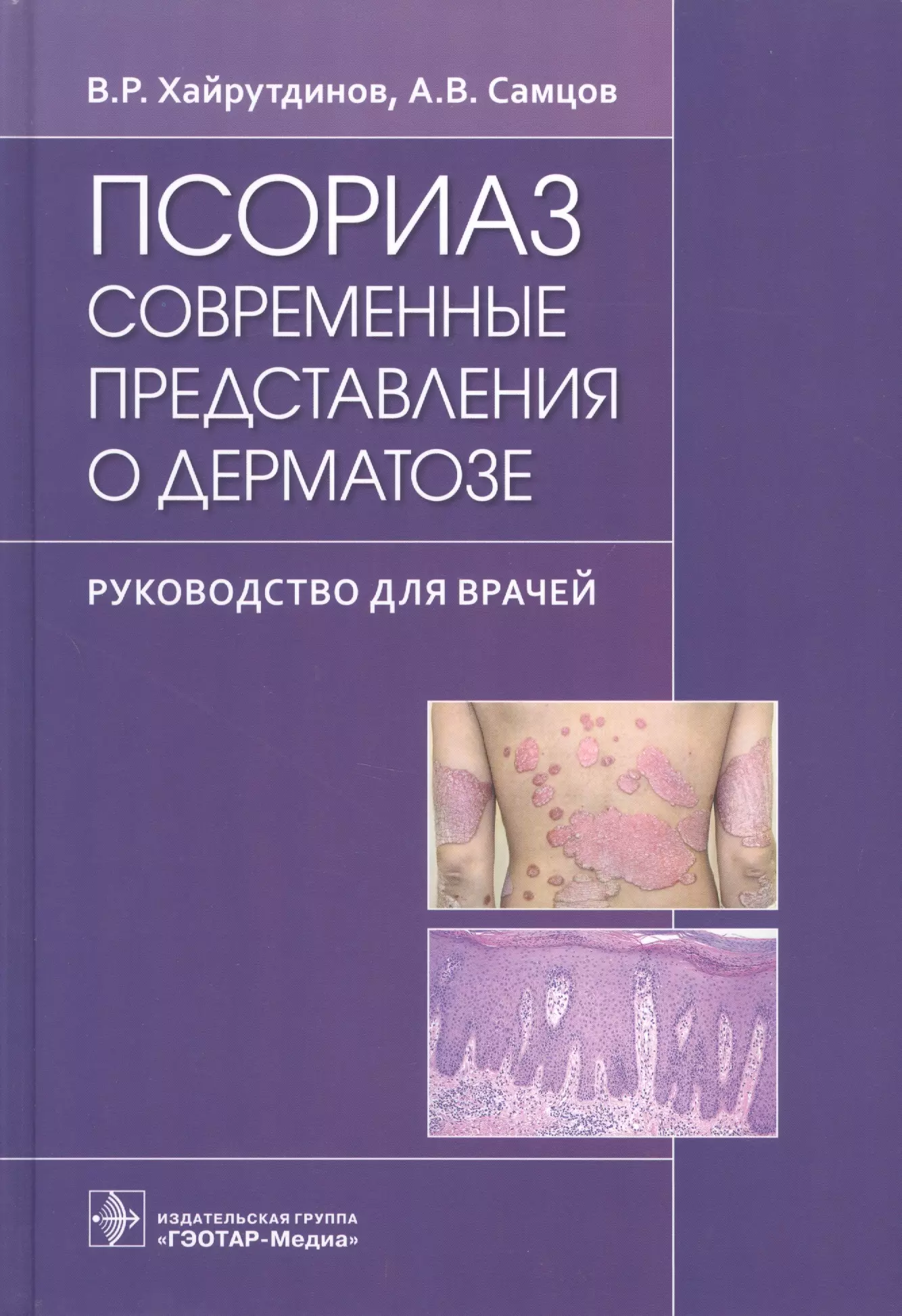 Псориаз. Современные представления о дерматозе. Руководство для врачей.