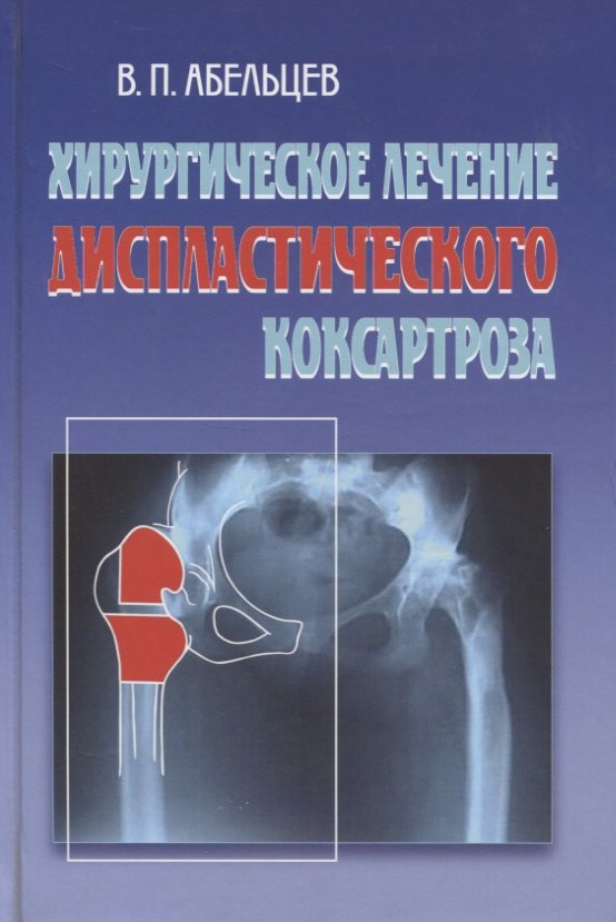 

Хирургическое лечение диспластического коксартроза