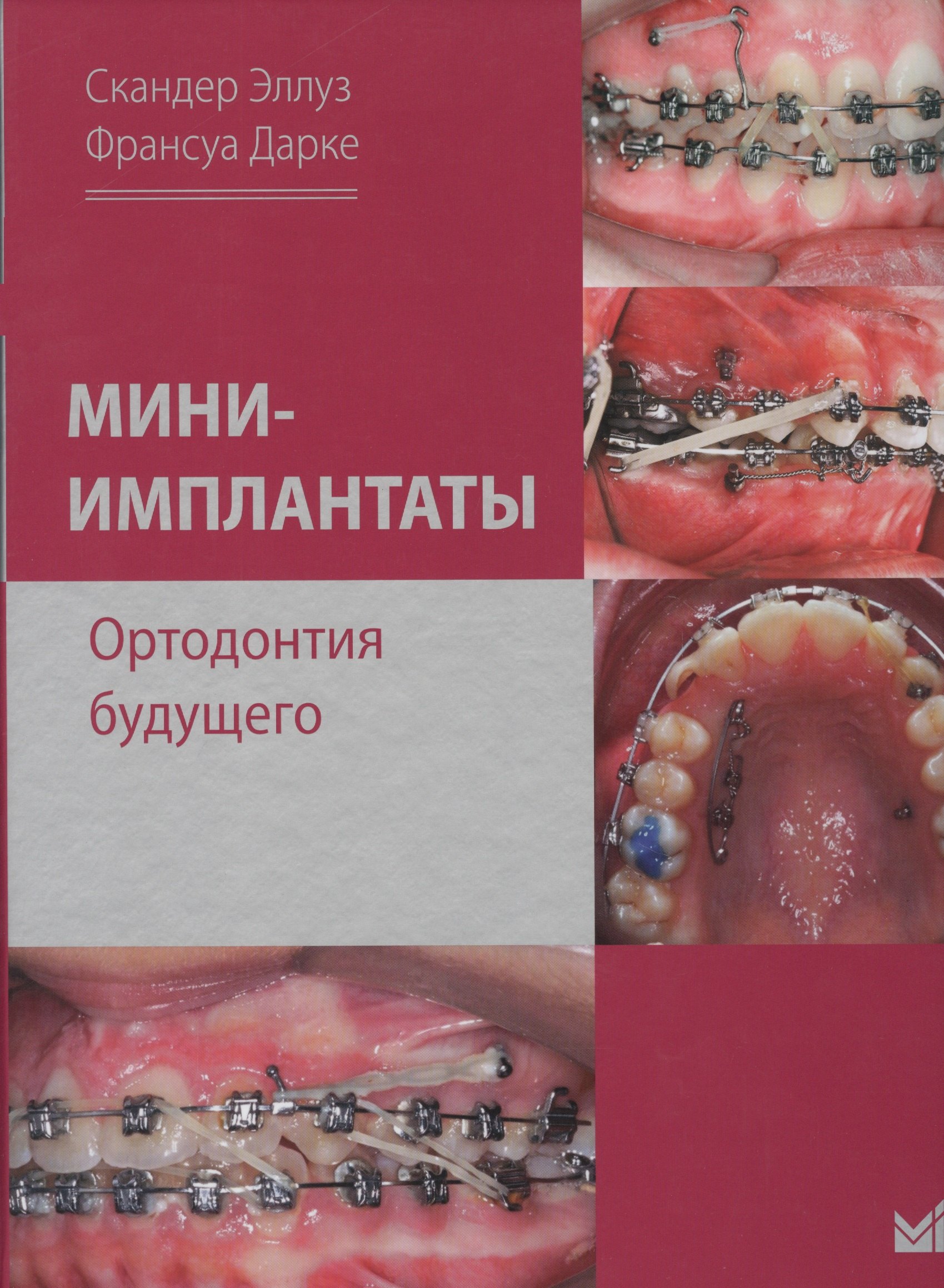 Эллуз Скандер: Мини-имплантаты. Ортодонтия будущего.