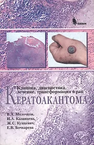Купить Кератоакантома. Клиника, диагностика, лечение, трансформация в рак — Фото №1