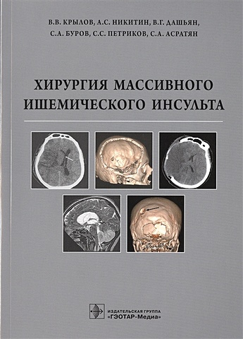 Крылов В., Никитин А., Дашьян В., Буров С. и др Хирургия массивного ишемического инсульта