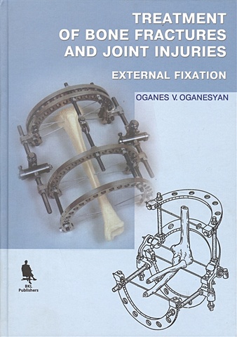 Treatment of Bone Fractures and Joint Injuries. External Fixation (книга на английском языке) c type self locking quick joint of air compressor sp20 sm sh sf pp ph pm pf pneumatic pipe joint