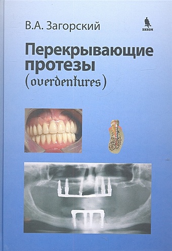 Загорский В. Перекрывающие протезы (overdentures) муслов с арутюнов с механические свойства зуба и околозубных тканей монография