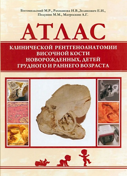Атлас клинической рентгеноанатомии височной кости новорожденных, детей ...
