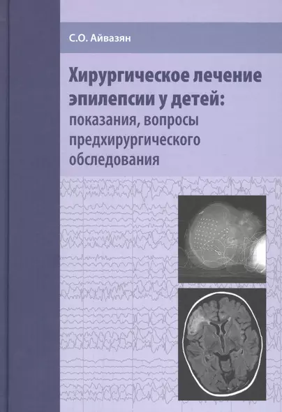 Хирургическое лечение эпилепсии у детей: показания, вопросы предхирургического обследования - фото 1