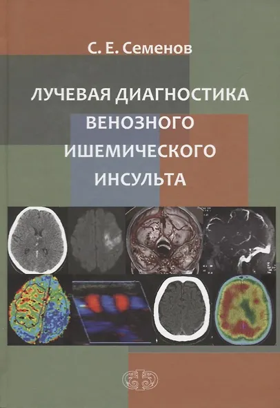 Лучевая диагностика венозного ишемического инсульта - фото 1