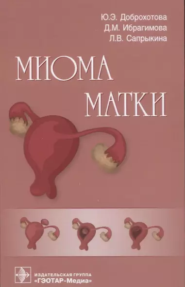 Миома матки - фото 1