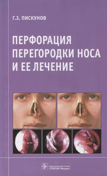Перфорация перегородки носа и ее лечение. - фото 1