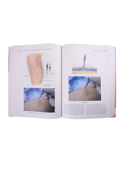 Атлас эндоваскулярной венозной хирургии - фото 6