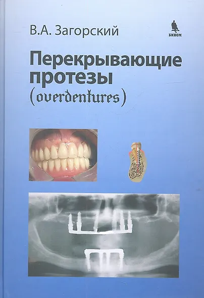 Перекрывающие протезы (overdentures) - фото 2