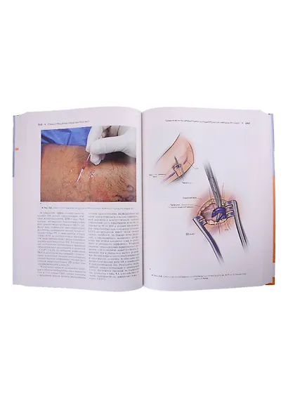 Атлас эндоваскулярной венозной хирургии - фото 5