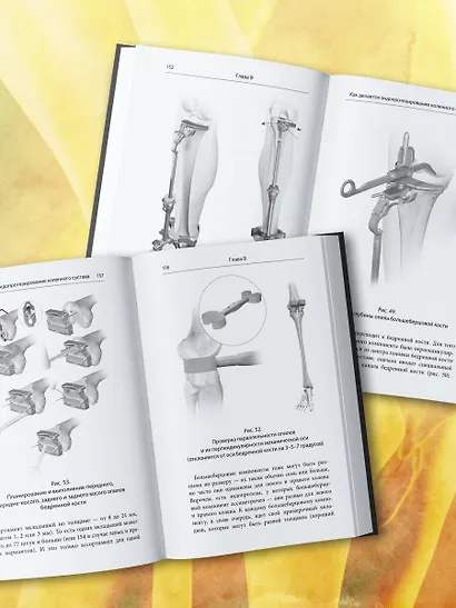 Эндопротезирование коленного сустава: ответы практикующего врача на все вопросы пациентов - фото 10