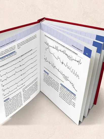 Атлас электрокардиографии. Интерпретация результатов: от простого к сложному - фото 11