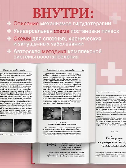 Лечение пиявками. Схемы гирудотерапии при сложных, хронических и запущенных заболеваниях - фото 6