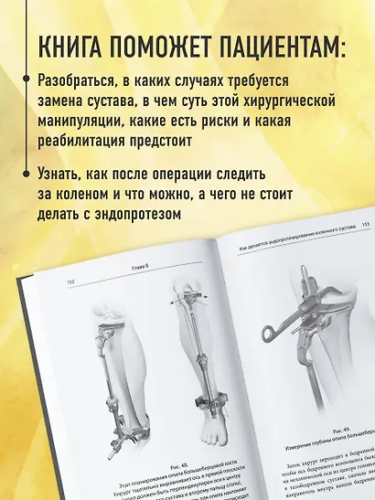 Эндопротезирование коленного сустава: ответы практикующего врача на все вопросы пациентов - фото 6