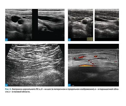 Лимфатические узлы в ультразвуковой диагностике - фото 5