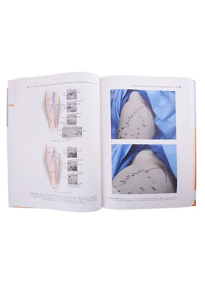 Атлас эндоваскулярной венозной хирургии - фото 4