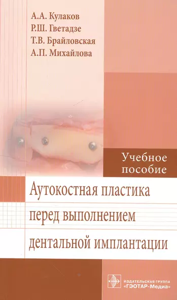 Аутокостная пластика перед выполнением дентальной имплантации. - фото 1