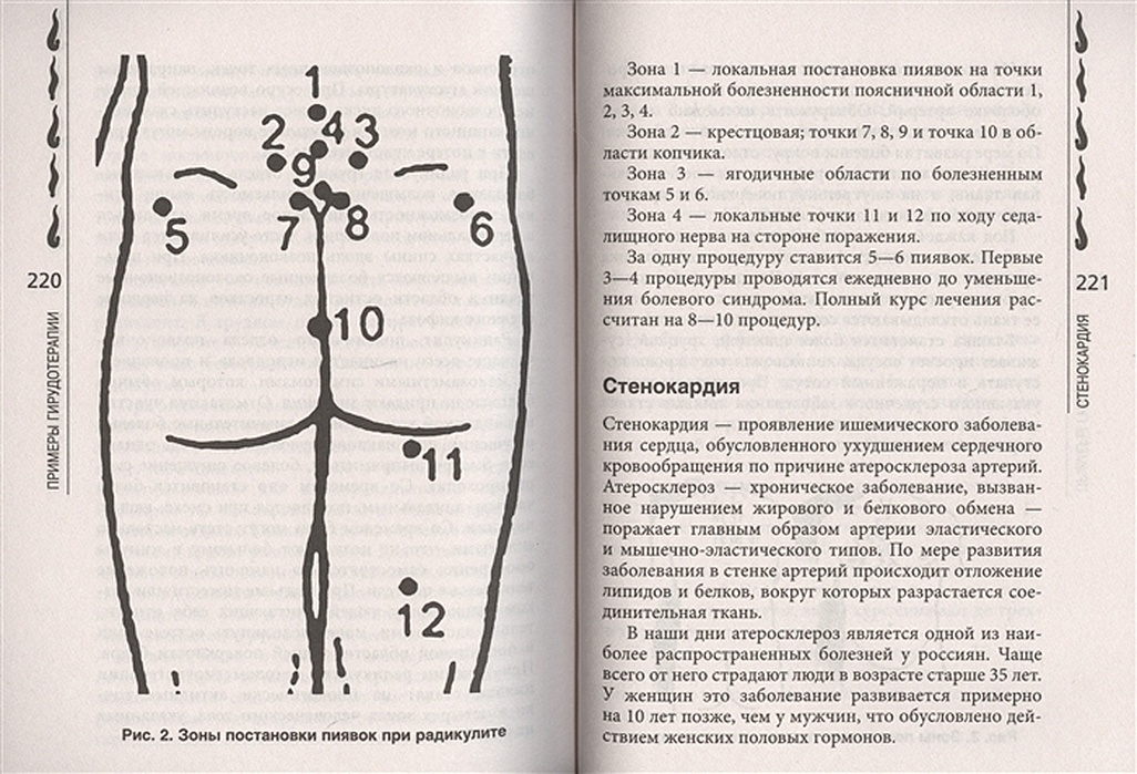 Куда ставить пиявки при гипертонии картинки