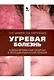 Угревая болезнь. Комбинированная лазерная и фотодинамическая терапия - фото 1