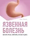 Язвенная болезнь. Факторы риска, симптомы, лечение и диета - фото 1