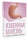 Язвенная болезнь. Факторы риска, симптомы, лечение и диета - фото 3
